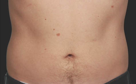 Coolsculpting Abdomen Before and After | Little Lipo