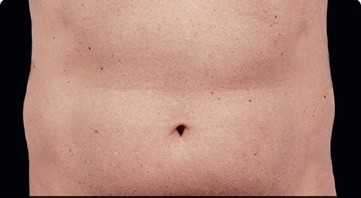 Coolsculpting Abdomen Before and After | Little Lipo