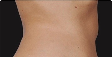 Coolsculpting Abdomen Before and After | Little Lipo