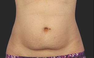 Coolsculpting Abdomen Before and After | Little Lipo