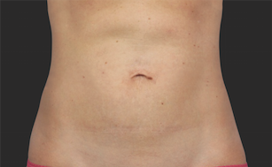 Coolsculpting Abdomen Before and After | Little Lipo