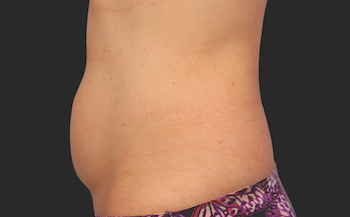 Coolsculpting Abdomen Before and After | Little Lipo