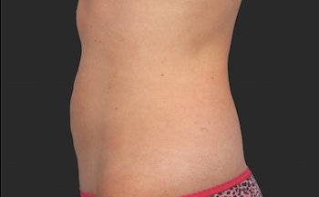 Coolsculpting Abdomen Before and After | Little Lipo