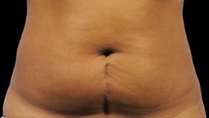 Coolsculpting Abdomen Before and After | Little Lipo