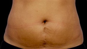 Coolsculpting Abdomen Before and After | Little Lipo