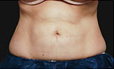 Coolsculpting Abdomen Before and After | Little Lipo