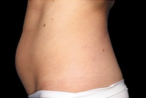 Coolsculpting Abdomen Before and After | Little Lipo