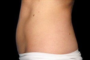 Coolsculpting Abdomen Before and After | Little Lipo