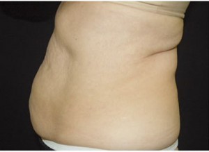 Coolsculpting Abdomen Before and After | Little Lipo