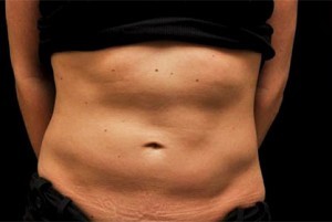 Coolsculpting Abdomen Before and After | Little Lipo