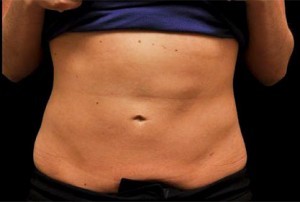 Coolsculpting Abdomen Before and After | Little Lipo