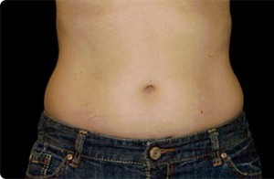 Coolsculpting Abdomen Before and After | Little Lipo