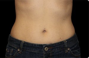 Coolsculpting Abdomen Before and After | Little Lipo