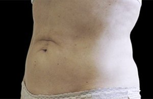 Coolsculpting Abdomen Before and After | Little Lipo