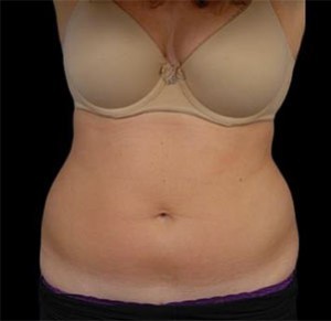 Coolsculpting Abdomen Before and After | Little Lipo