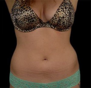 Coolsculpting Abdomen Before and After | Little Lipo