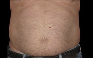 Coolsculpting Abdomen Before and After | Little Lipo