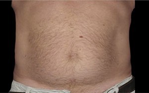 Coolsculpting Abdomen Before and After | Little Lipo