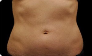 Coolsculpting Abdomen Before and After | Little Lipo