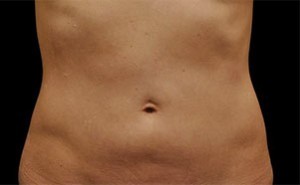 Coolsculpting Abdomen Before and After | Little Lipo