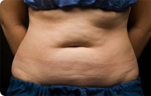 Coolsculpting Abdomen Before and After | Little Lipo