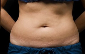 Coolsculpting Abdomen Before and After | Little Lipo