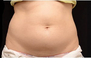 Coolsculpting Abdomen Before and After | Little Lipo