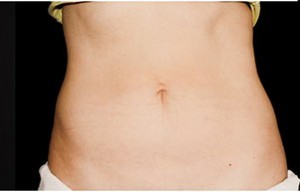 Coolsculpting Abdomen Before and After | Little Lipo