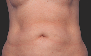 Coolsculpting Abdomen Before and After | Little Lipo