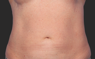 Coolsculpting Abdomen Before and After | Little Lipo