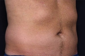 Coolsculpting Abdomen Before and After | Little Lipo