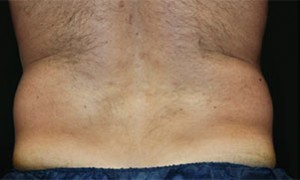 Coolsculpting Abdomen Before and After | Little Lipo