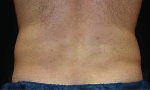 Coolsculpting Abdomen Before and After | Little Lipo