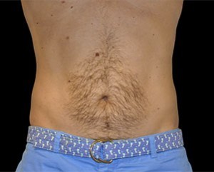 Coolsculpting Abdomen Before and After | Little Lipo