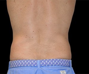 Coolsculpting Abdomen Before and After | Little Lipo