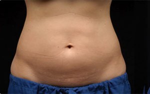 Coolsculpting Abdomen Before and After | Little Lipo