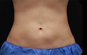 Coolsculpting Abdomen Before and After | Little Lipo