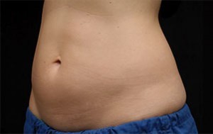 Coolsculpting Abdomen Before and After | Little Lipo