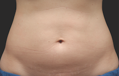 Coolsculpting Abdomen Before and After | Little Lipo