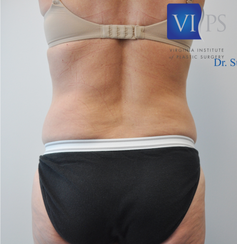 Coolsculpting Flank Before and After | Little Lipo