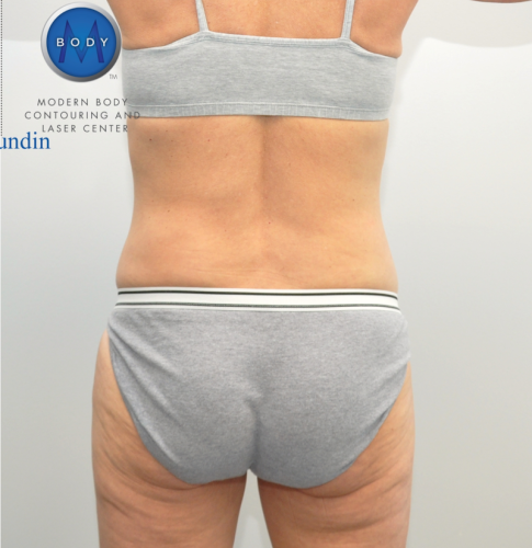 Coolsculpting Flank Before and After | Little Lipo