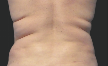 Coolsculpting Flank Before and After | Little Lipo