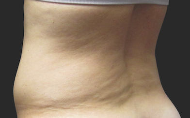 Coolsculpting Flank Before and After | Little Lipo