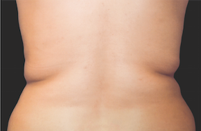 Coolsculpting Flank Before and After | Little Lipo