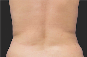 Coolsculpting Flank Before and After | Little Lipo