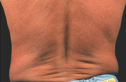 Coolsculpting Flank Before and After | Little Lipo