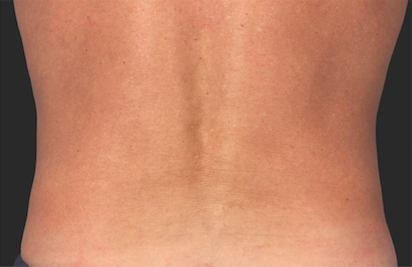 Coolsculpting Flank Before and After | Little Lipo