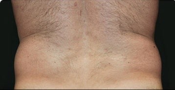 Coolsculpting Flank Before and After | Little Lipo