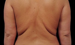 Coolsculpting Flank Before and After | Little Lipo