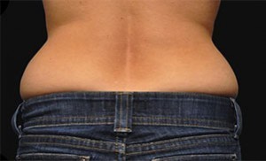 Coolsculpting Flank Before and After | Little Lipo